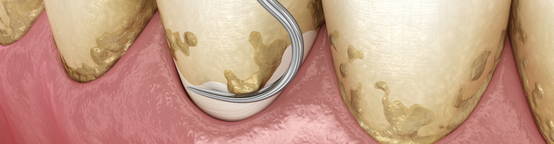 dental scraper removing buildup from front of teeth
